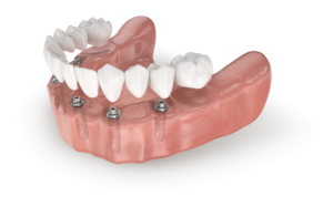 Náhrada všech zubů implantáty LASAK